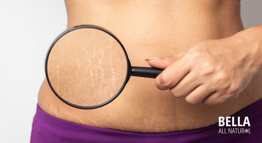 Does Collagen Reduce the Appearance of Stretch Marks?
