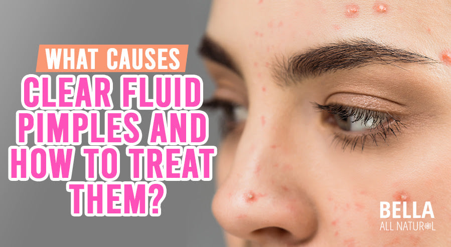 What Is The Clear Liquid That Comes Out Of Zits